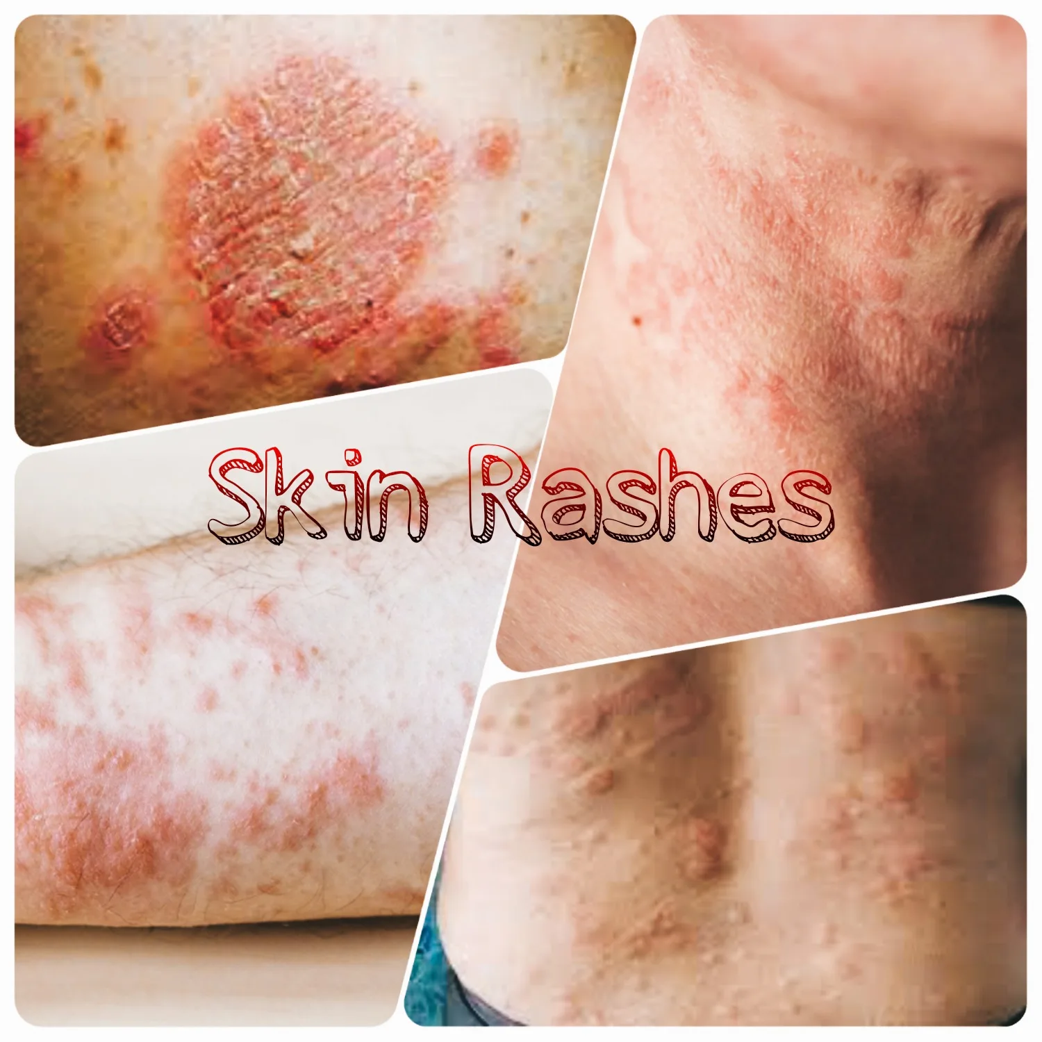 Skin Rashes: Symptoms, And Treatment - Trending Blogs