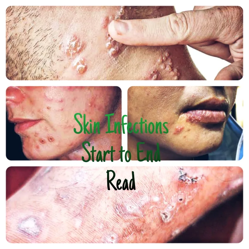 Skin Infection or Skin Infections