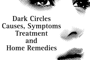 Dark circles causes, symptoms, treatment and home remedies